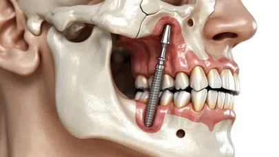 İmplantta Neden 3 Ay Beklenir?