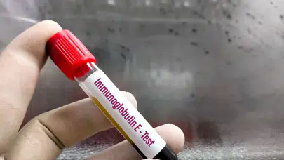 Ankara Alerji Testi Nerede Yapılır?